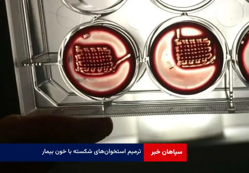 ترمیم استخوان‌ های شکسته با خون بیمار!