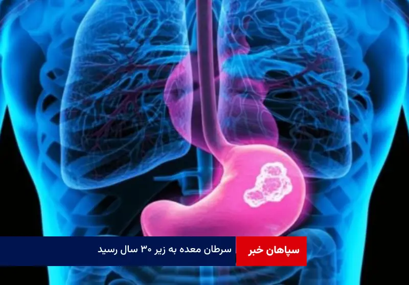 سرطان معده به زیر ۳۰ سال رسید