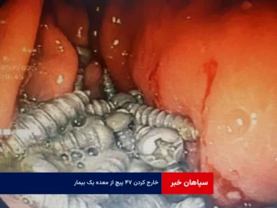 خارج کردن ۴۷ پیچ از معده یک بیمار!
