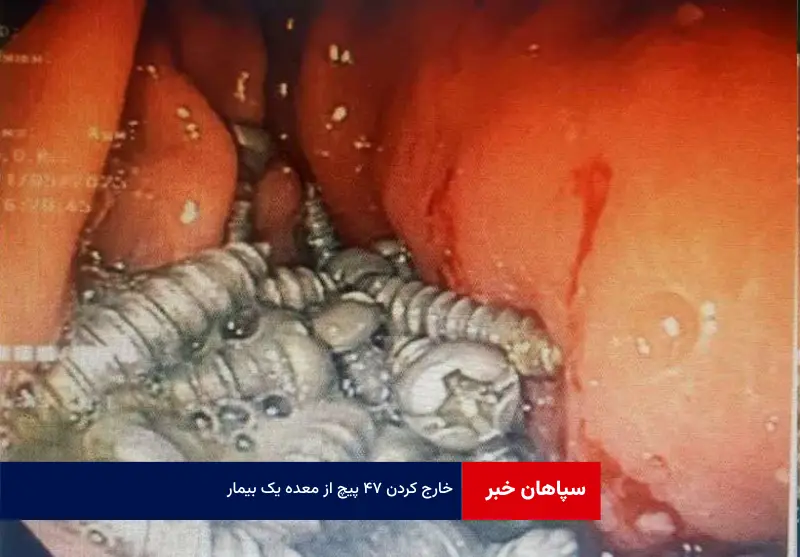 خارج کردن ۴۷ پیچ از معده یک بیمار!