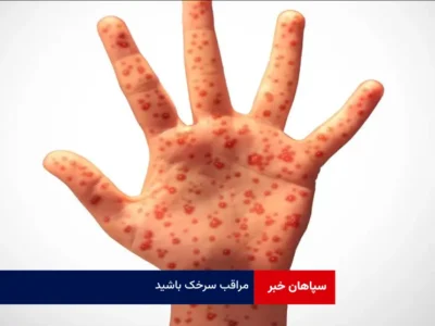 مراقب سرخک باشید