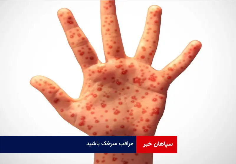 مراقب سرخک باشید