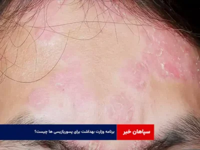 برنامه وزارت بهداشت برای پسوریازیسی ها چیست؟