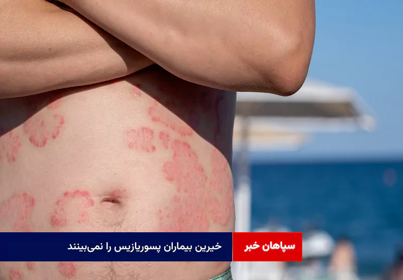 خیرین بیماران پسوریازیس را نمیبینند