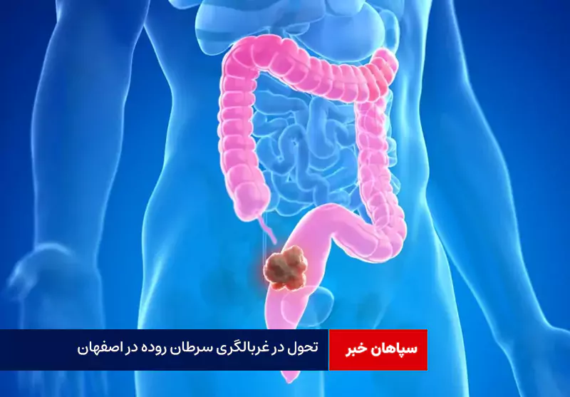 تحول در غربالگری سرطان روده در اصفهان