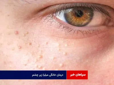 درمان خانگی میلیا زیر چشم + ۴ راهکار خانگی برای رفع سریع کیست‌های سفید