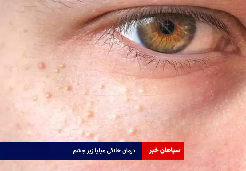 درمان خانگی میلیا زیر چشم + ۴ راهکار خانگی برای رفع سریع کیستهای سفید