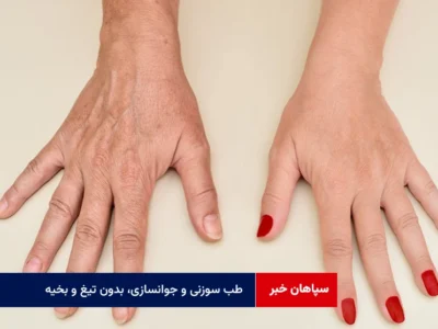 طب سوزنی و جوانسازی، بدون تیغ و بخیه