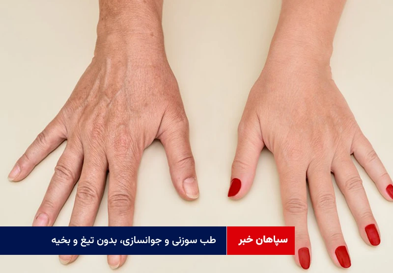 طب سوزنی و جوانسازی، بدون تیغ و بخیه