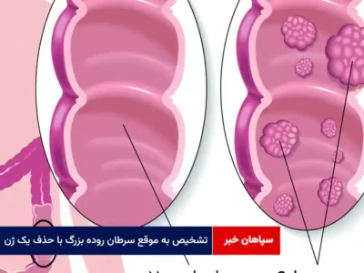 تشخیص به موقع سرطان روده بزرگ با حذف یک ژن