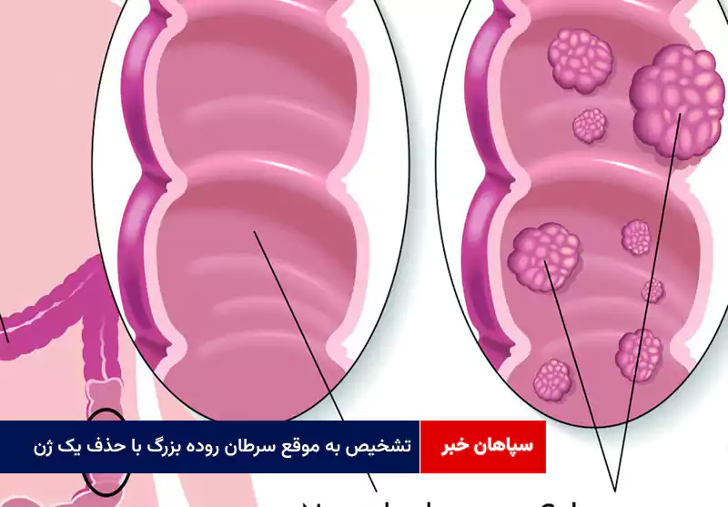 تشخیص به موقع سرطان روده بزرگ با حذف یک ژن