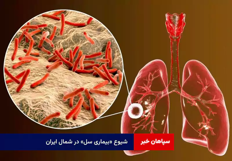 شیوع «بیماری سل» در شمال ایران