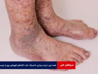 همه چیز درباره بیماری شامبرگ؛ علت بروز لکه‌های قهوه‌ای روی پا چیست؟