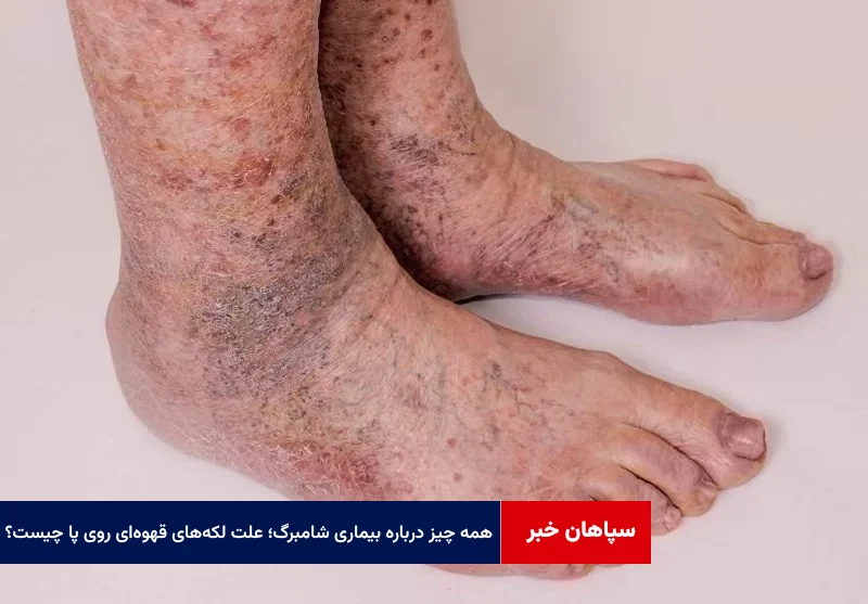 همه چیز درباره بیماری شامبرگ؛ علت بروز لکه‌های قهوه‌ای روی پا چیست؟