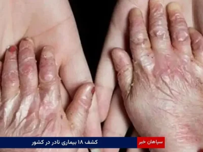 کشف ۱۸ بیماری نادر در کشور