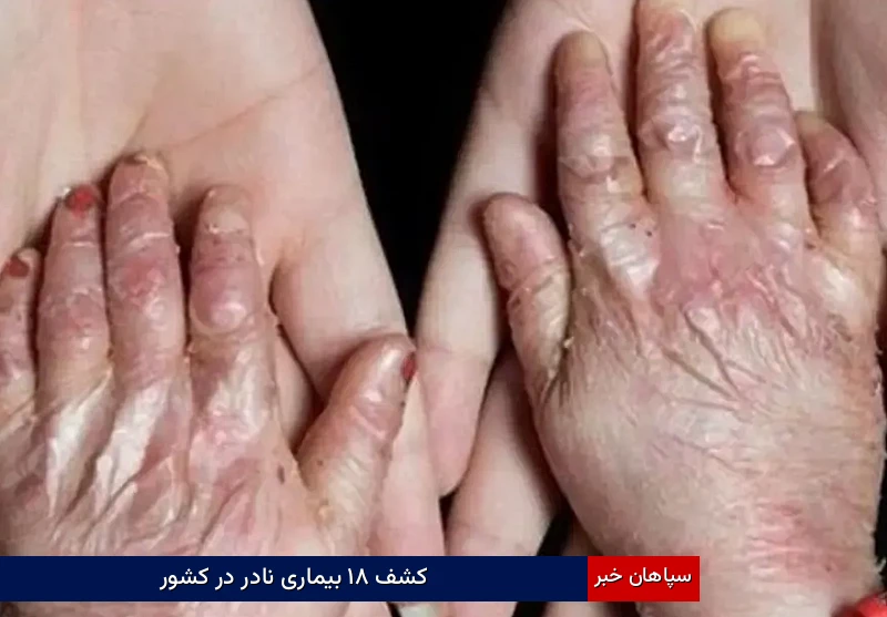 کشف ۱۸ بیماری نادر در کشور