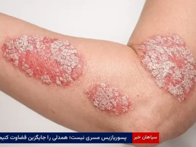 پسوریازیس مسری نیست؛ همدلی را جایگزین قضاوت کنیم