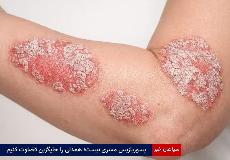 پسوریازیس مسری نیست؛ همدلی را جایگزین قضاوت کنیم