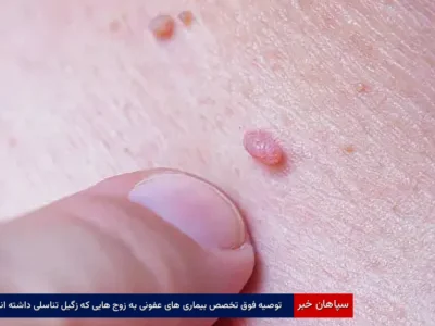 توصیه فوق تخصص بیماری های عفونی به زوج هایی که زگیل تناسلی داشته اند