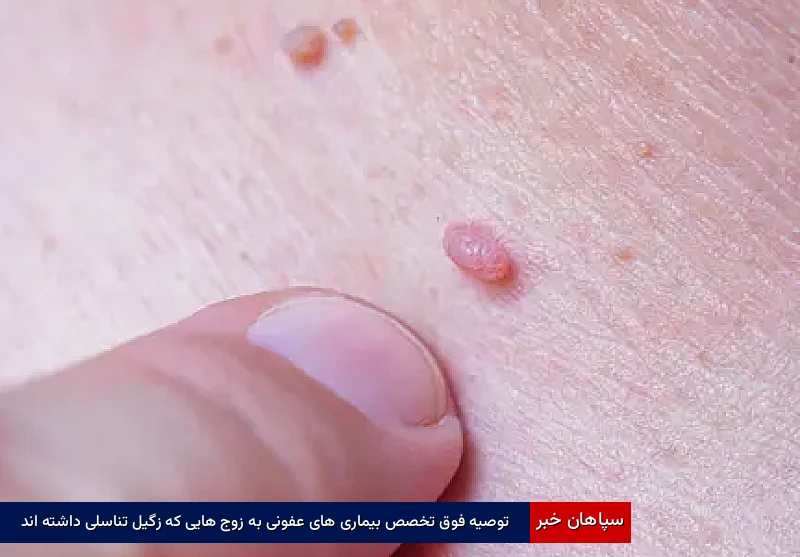 توصیه فوق تخصص بیماری های عفونی به زوج هایی که زگیل تناسلی داشته اند